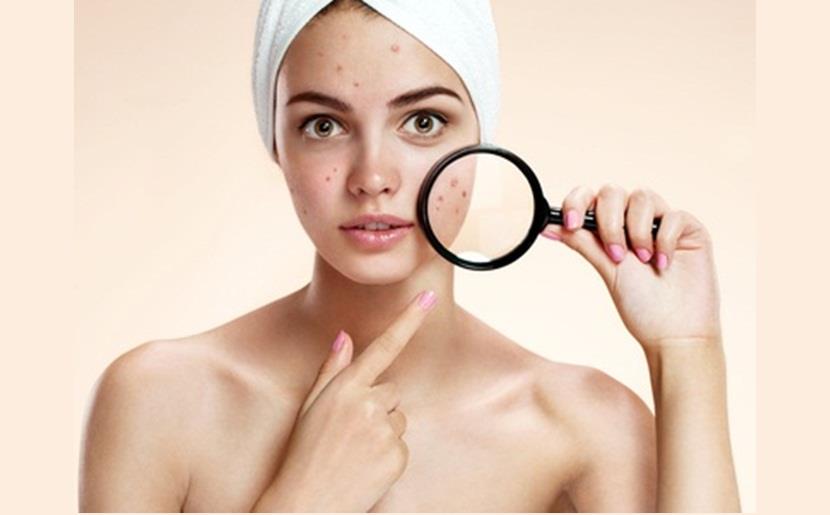 An Overview on Acne Treatment! 